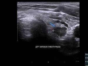 US parathyroid adenoma